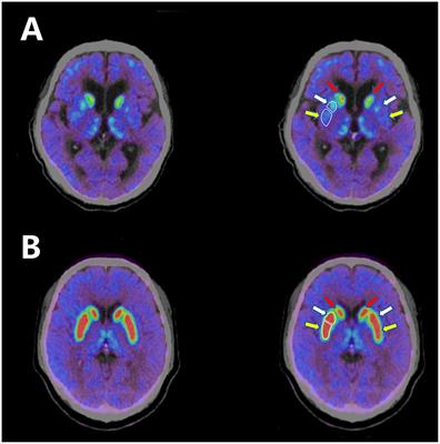 Parkinson's disease and comorbid myasthenia gravis: a case report and literature review